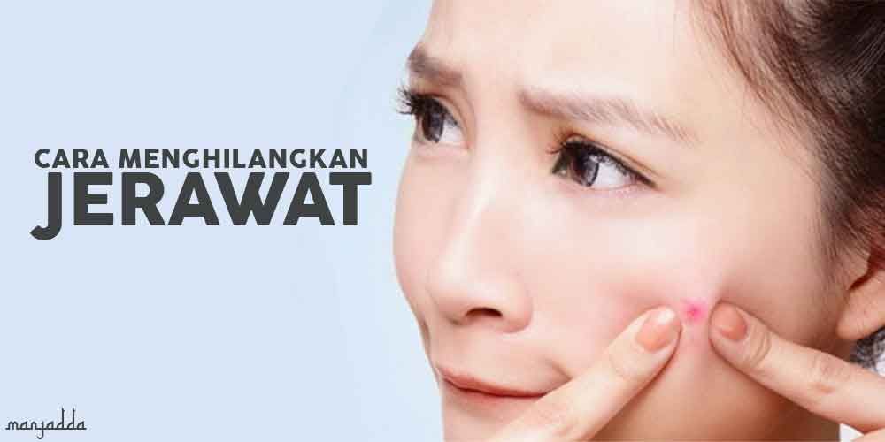 Cream Penghilang Jerawat dan Bekasnya, Ampuh !! Cream Penghilang Jerawat dan Bekasnya, Ampuh !!